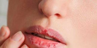 Labios resecos: ¿Por qué pasa y qué hacer?