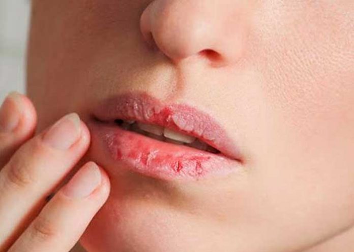 Labios resecos: ¿Por qué pasa y qué hacer?