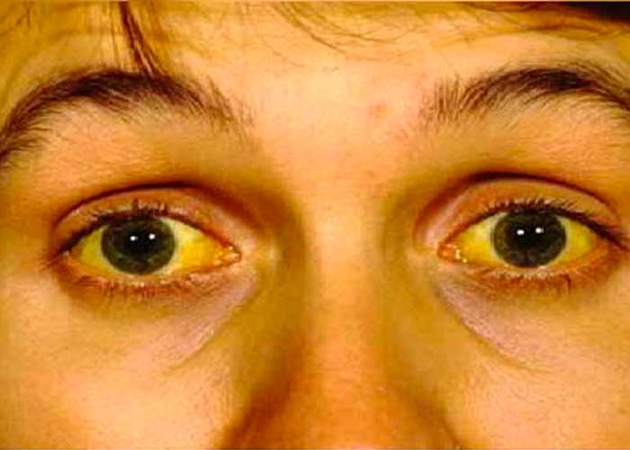 ¿Qué enfermedades se pueden detectar a través de los ojos?