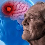 EE.UU. autoriza nuevo tratamiento para la enfermedad de Alzheimer