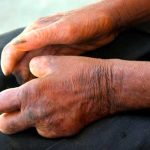 La lepra está controlada en la República Dominicana