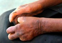 La lepra está controlada en la República Dominicana