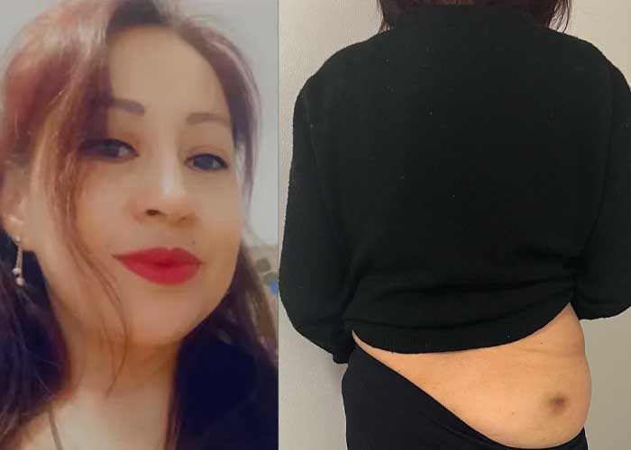 Soñaba con gluteos de impacto y quedó fatal