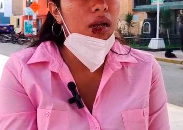 En Perú hombre le desfiguró el rostro a su novia por no responderle las llamadas