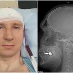 Se hizo cirugía cerebral perforando el cráneo "para controlar los sueños"