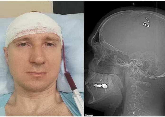 Se hizo cirugía cerebral perforando el cráneo 
