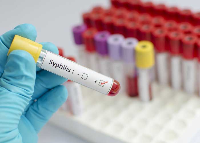 Reportan alarmante aumento de sífilis en Houston, Estados Unidos
