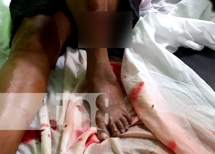 Foto: Adolescente gravemente lesionado tras fuerte accidente en Teotecacinte, Jalapa / TN8