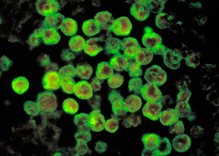 Muere tras infectarse con una ameba comecerebros