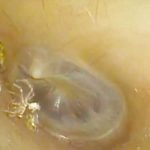 Araña sorprende a un médico en el oído de una paciente (Video)