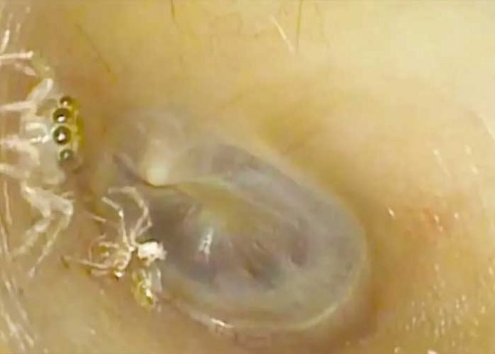 Araña sorprende a un médico en el oído de una paciente (Video)