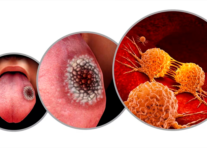 Foto: No ignores estos síntomas de cáncer oral /cortesía 