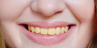 Remedio casero que “barre” el color amarillo de los dientes