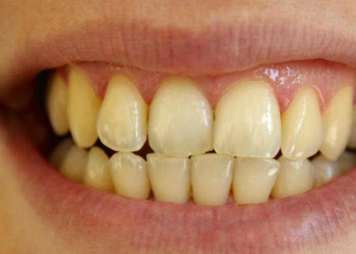Remedio casero que “barre” el color amarillo de los dientes