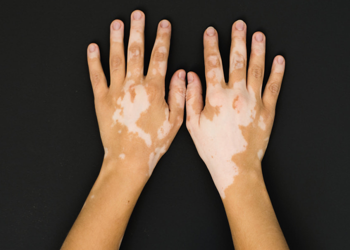 Foto: Prevención de enfermedades de la piel en Nicaragua 